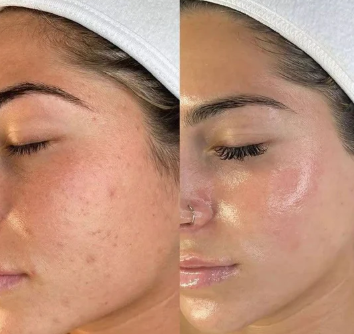 Rice Peel Shot Glow Ampoule
