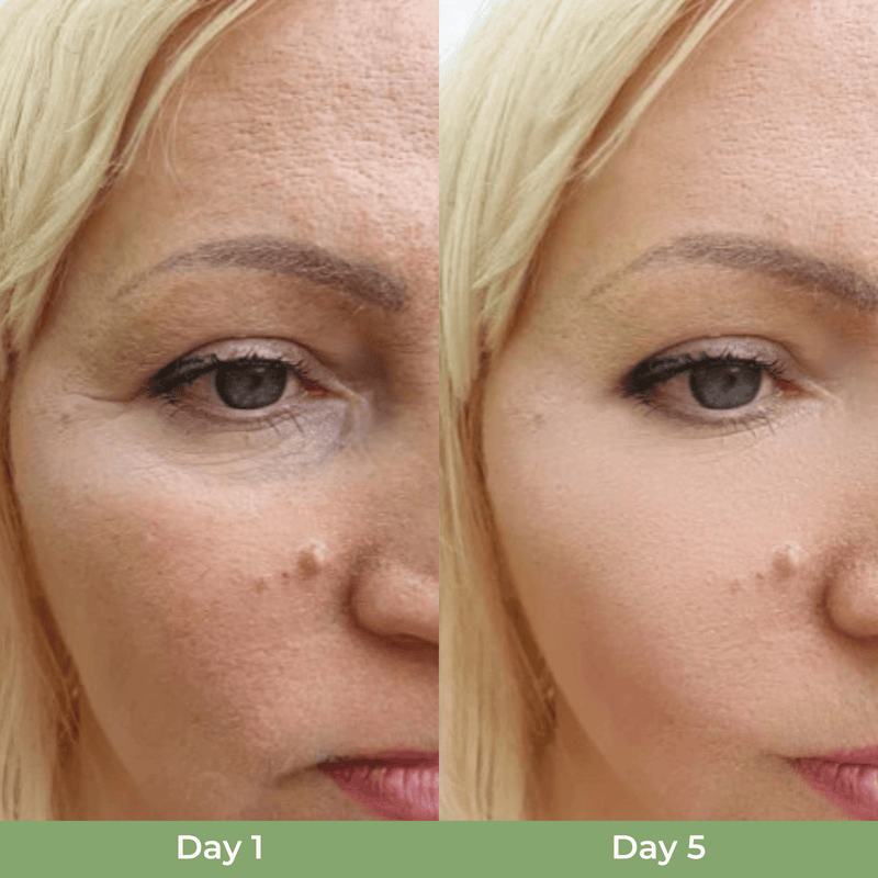 Before and after comparison of facial skin showing improved smoothness and more even appearance