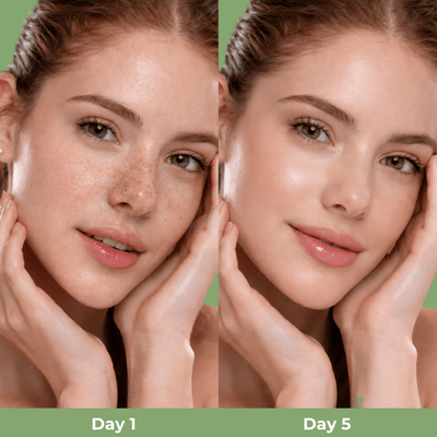 Day 1 vs Day 5 blackhead comparison showing smoother clearer nose pores after using Olivine Beauty Cactox Nose Pore Pack