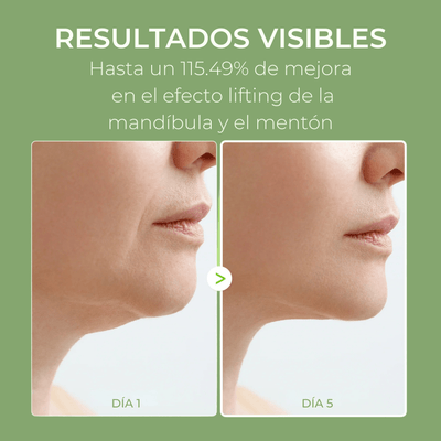 Resultados visibles de Olivine Beauty Cactox V-Lifting Mewing Band mostrando una apariencia más firme de mandíbula y mentón