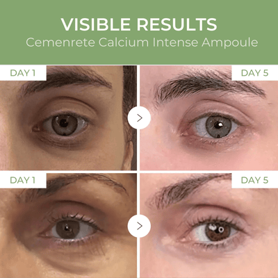 Under-eye appearance comparison showing visible improvement from day 1 to day 5 using Calcium Intense Ampoule Plus