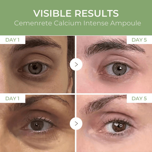 Under-eye appearance comparison showing visible improvement from day 1 to day 5 using Calcium Intense Ampoule Plus