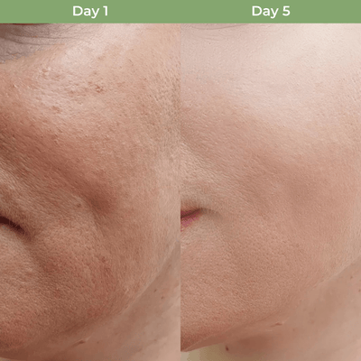 Close up before and after skin texture improvement using Olivine Beauty NAD plus peptide serum showing smoother appearance