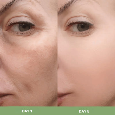 Skin texture improvement after using Olivine Beauty Peel Shot rice exfoliating ampoule