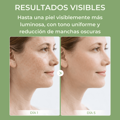 Comparación de piel antes y después usando la crema de ácido tranexámico de Olivine Beauty para mejorar manchas oscuras y tono desigual.